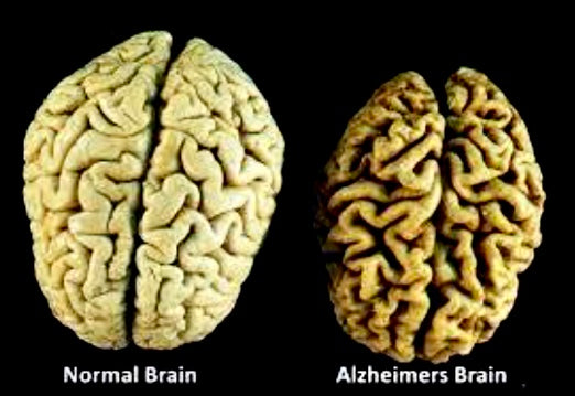 How Can I Prevent Alzheimer’s Disease? - Blog # 42